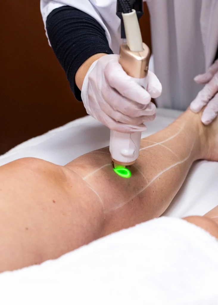 Épilation laser au centre Azure à Marnaz pour une épilation définitive.